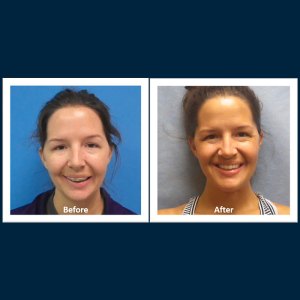 before and after photo of woman