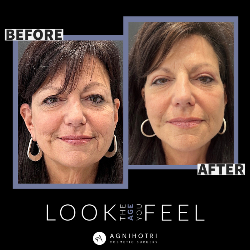 Fat transfer before and after