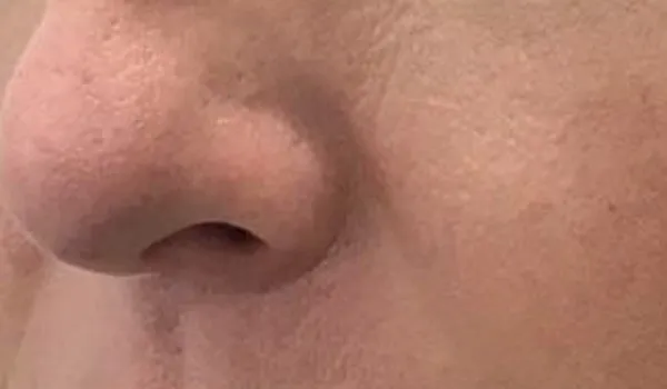 Scarless Mole & Skintag Removal after