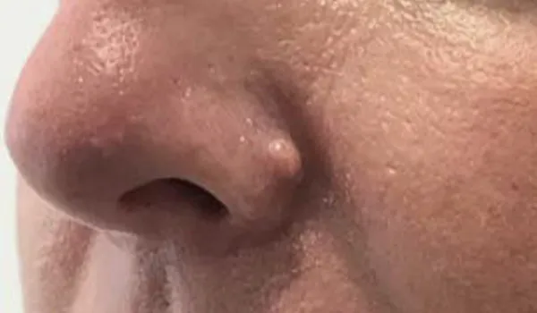 Scarless Mole & Skintag Removal before