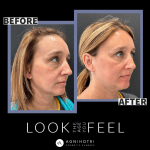 Photo of Blepharosplasty