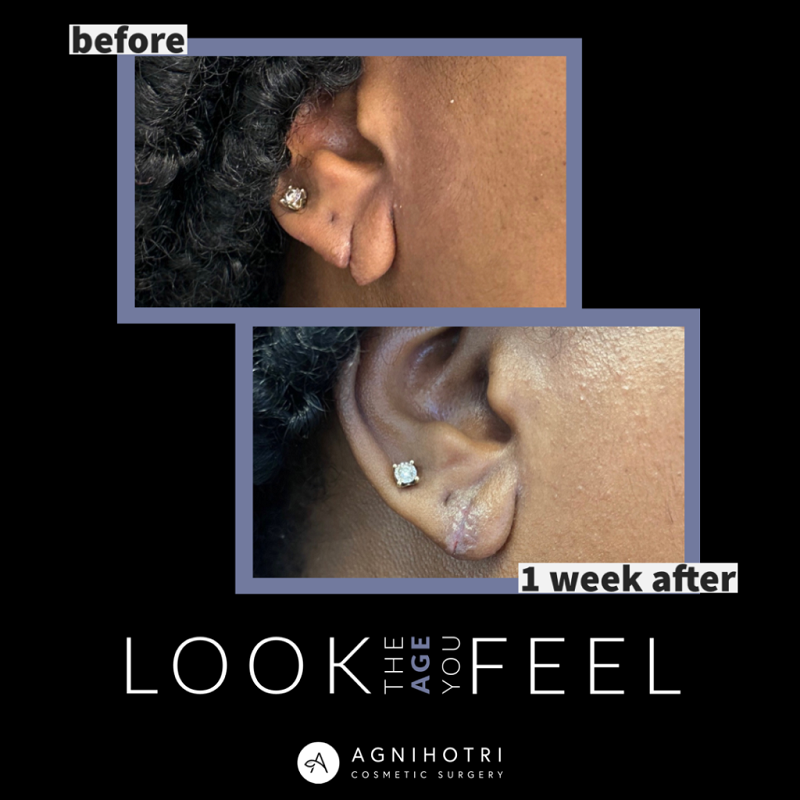 Earlobe Repair before and after