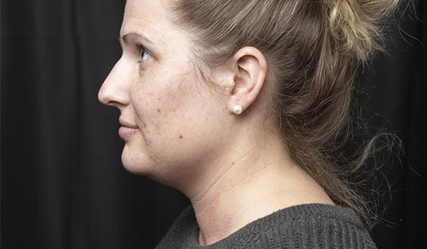 Face/Neck Lift & Contour before side view