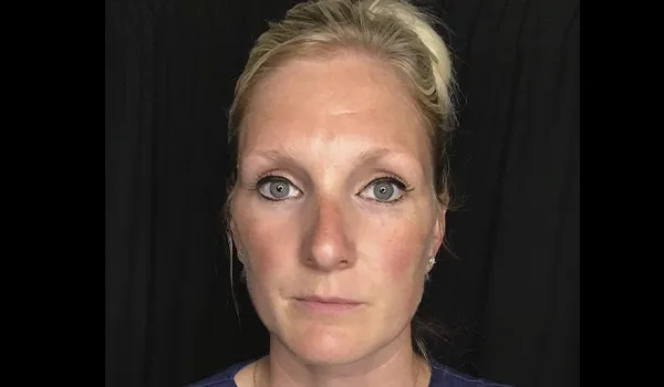 Osteoma after