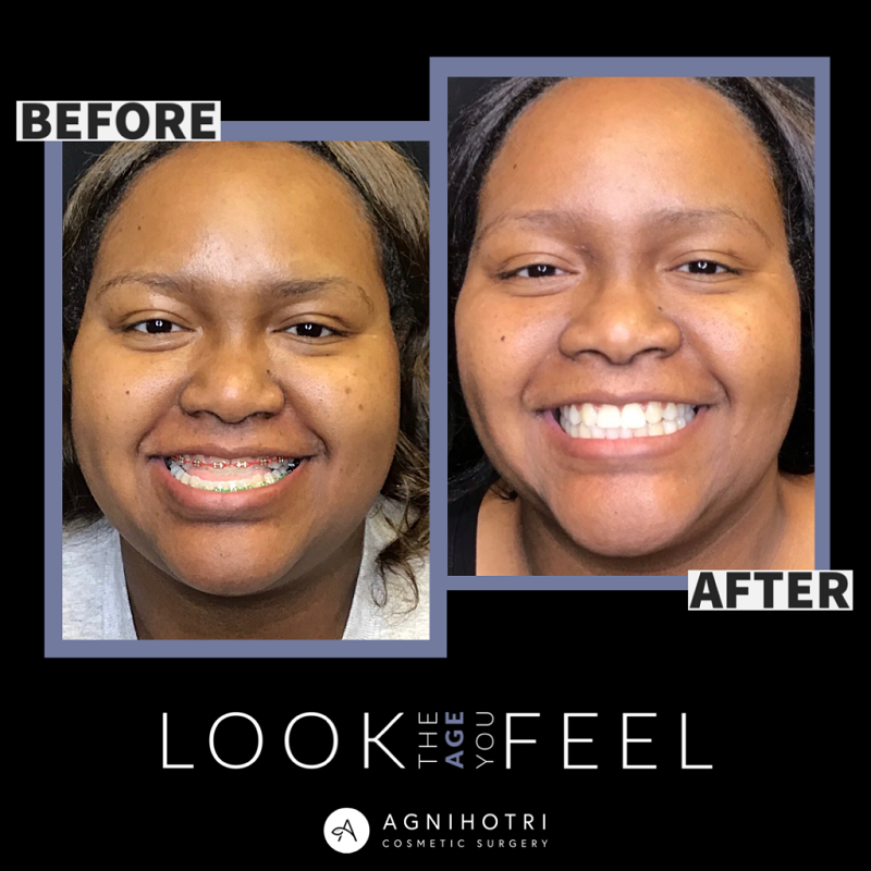 Jaw Surgery Before and After