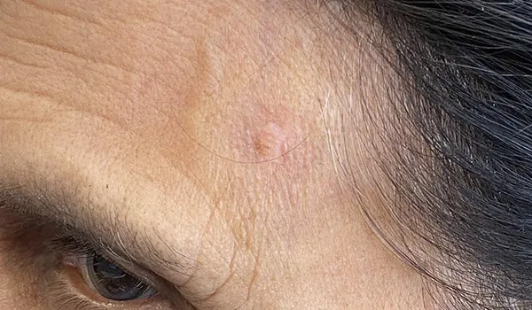Scarless Mole & Skintag Removal after