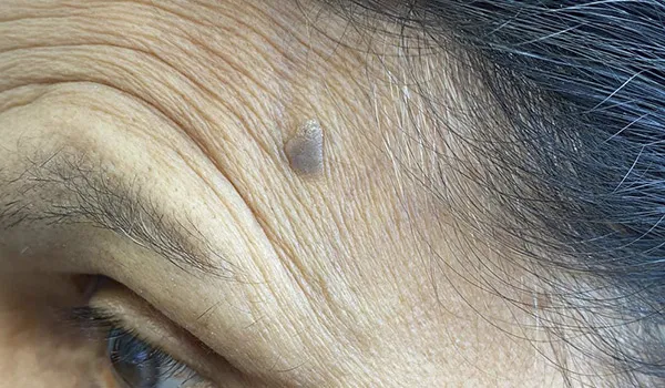 Scarless Mole & Skintag Removal before
