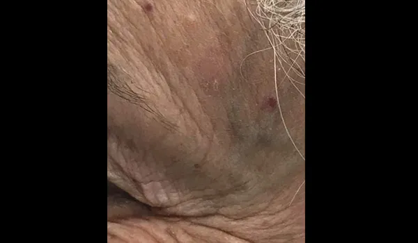 Scarless Mole & Skintag Removal after