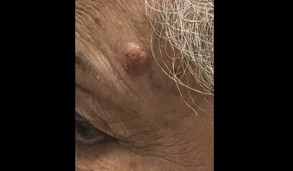 Scarless Mole & Skintag Removal before