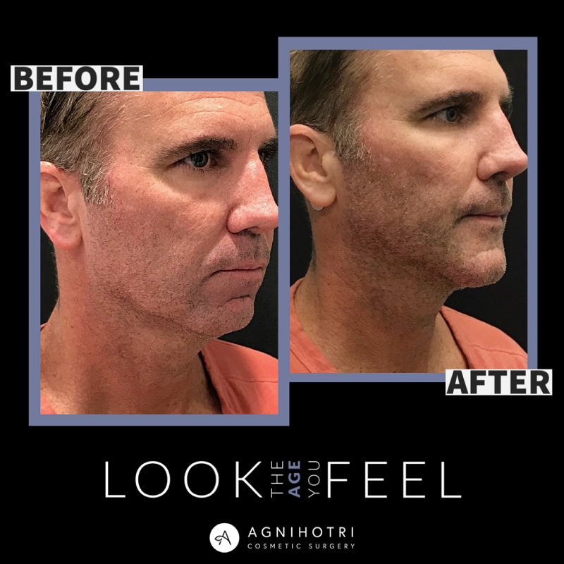 Facial Implants before and after