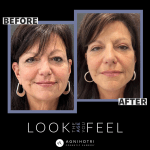 Photo of Face/Neck Lift