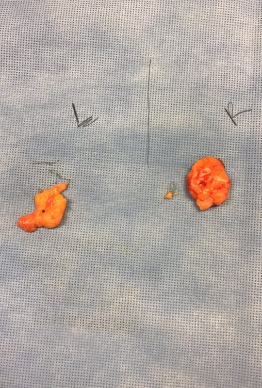 Buccal Fat Removal on surface for comparison
