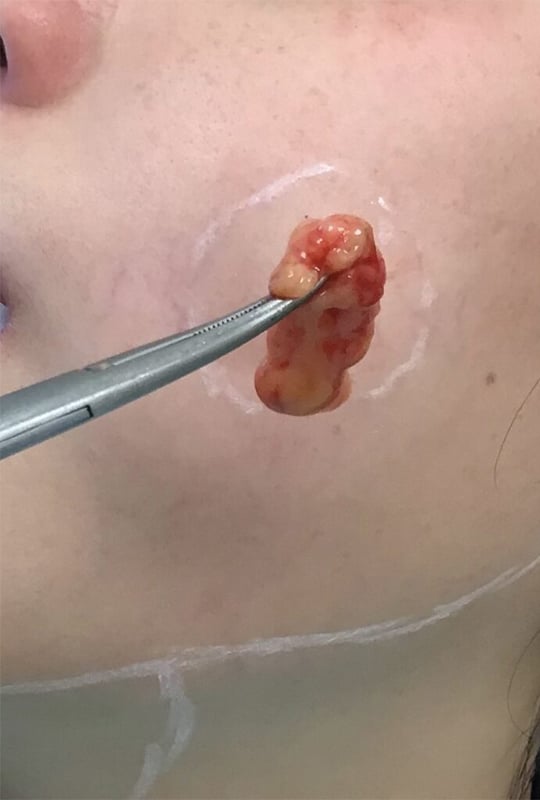 Buccal Fat Removal small