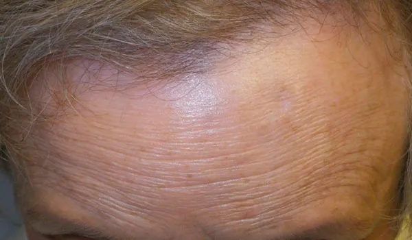 Osteoma after