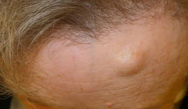 Osteoma before