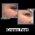 Photo of Botox