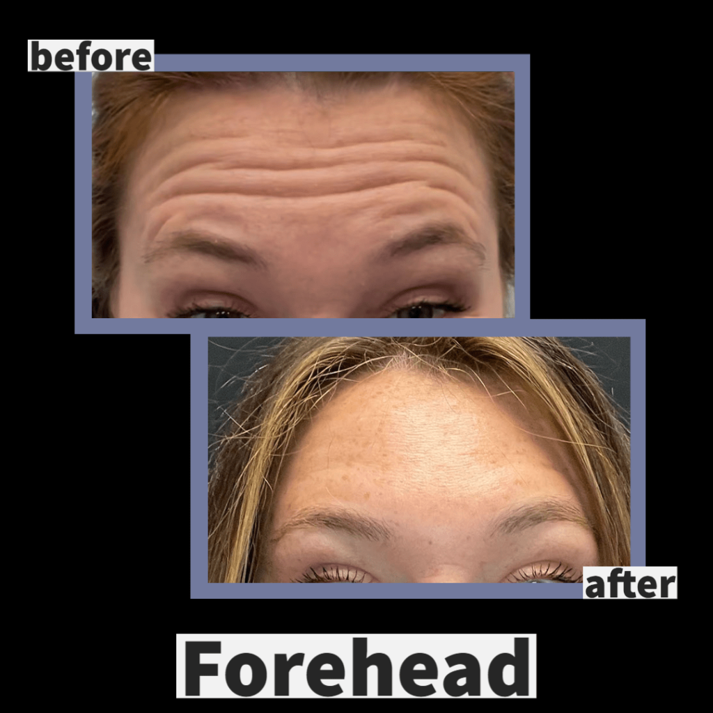 Photo of Botox