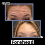 Photo of Botox