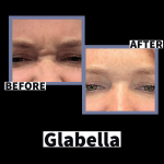 Photo of Botox