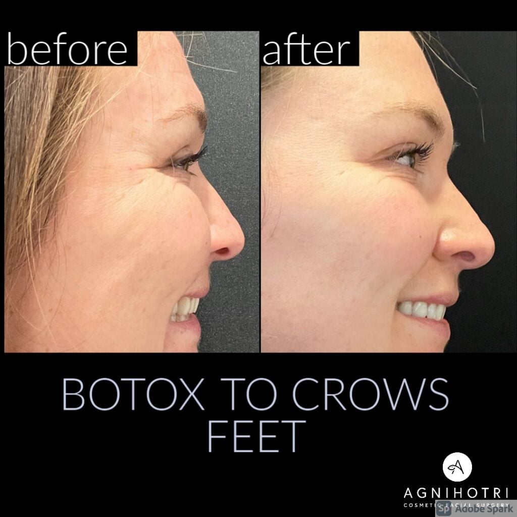 Photo of Botox