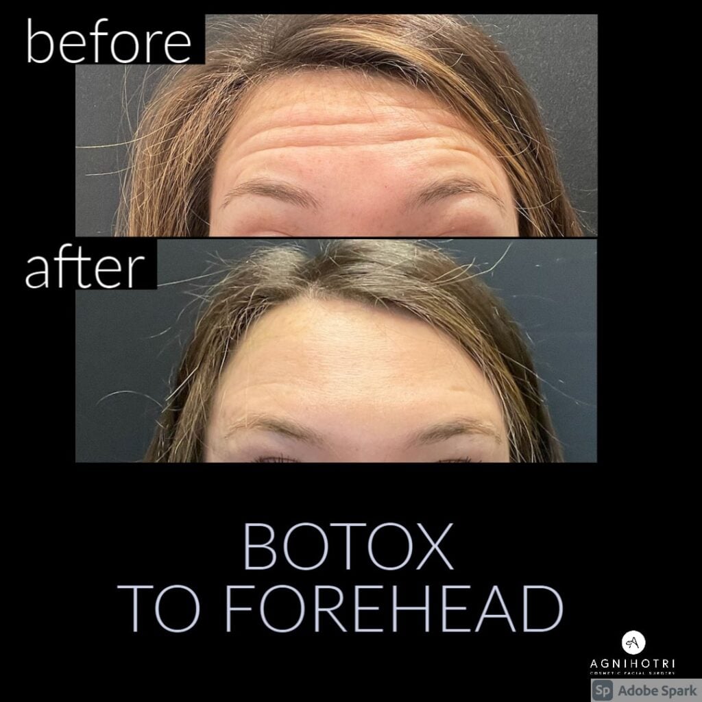 Photo of Botox