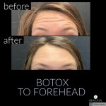 Photo of Botox