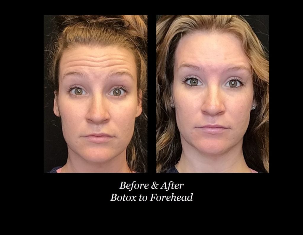 Photo of Botox