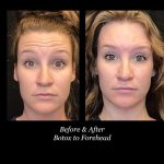 Photo of Botox