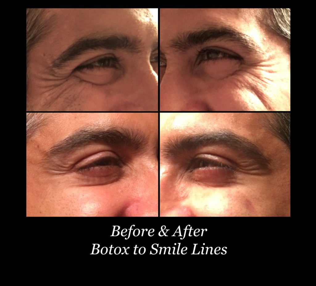 Photo of Botox