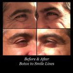Photo of Botox