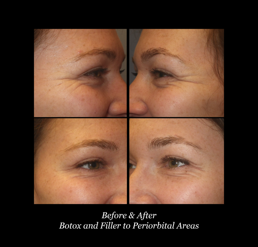 Photo of Botox