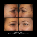 Photo of Botox