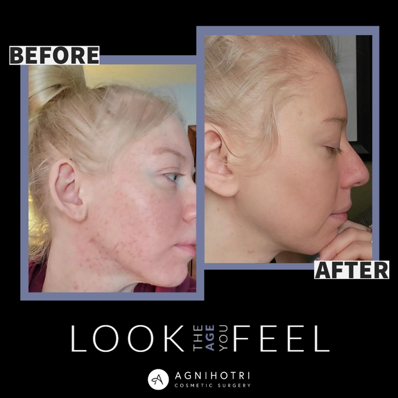 Collagen Induction before and after