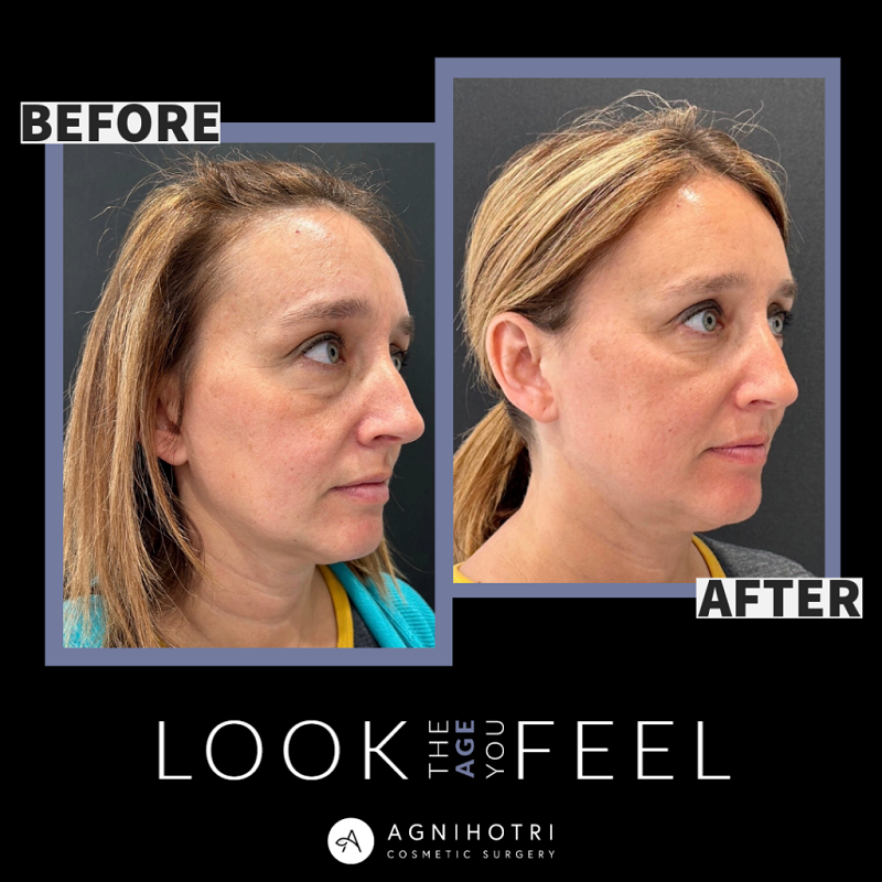 Eyelid Surgery before and after