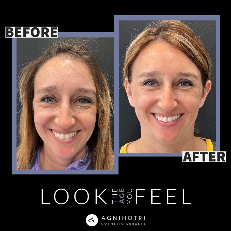 Eyelid Surgery before and after