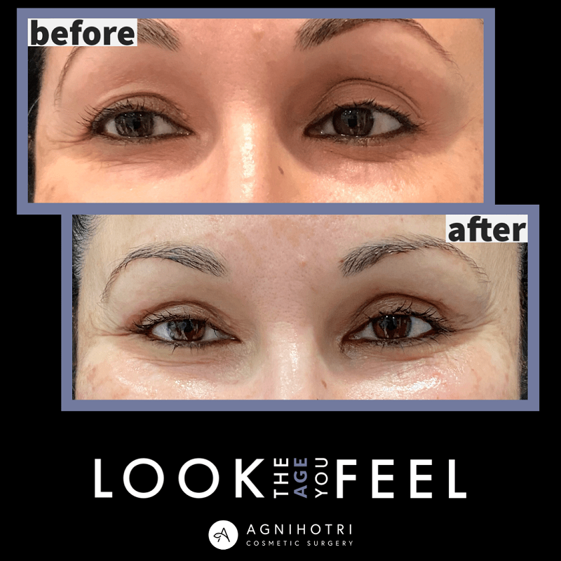 Eyelid Surgery before and after