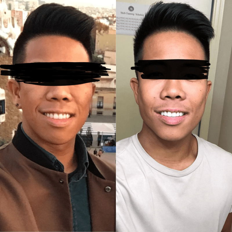 Buccal Fat Removal on patient transition 