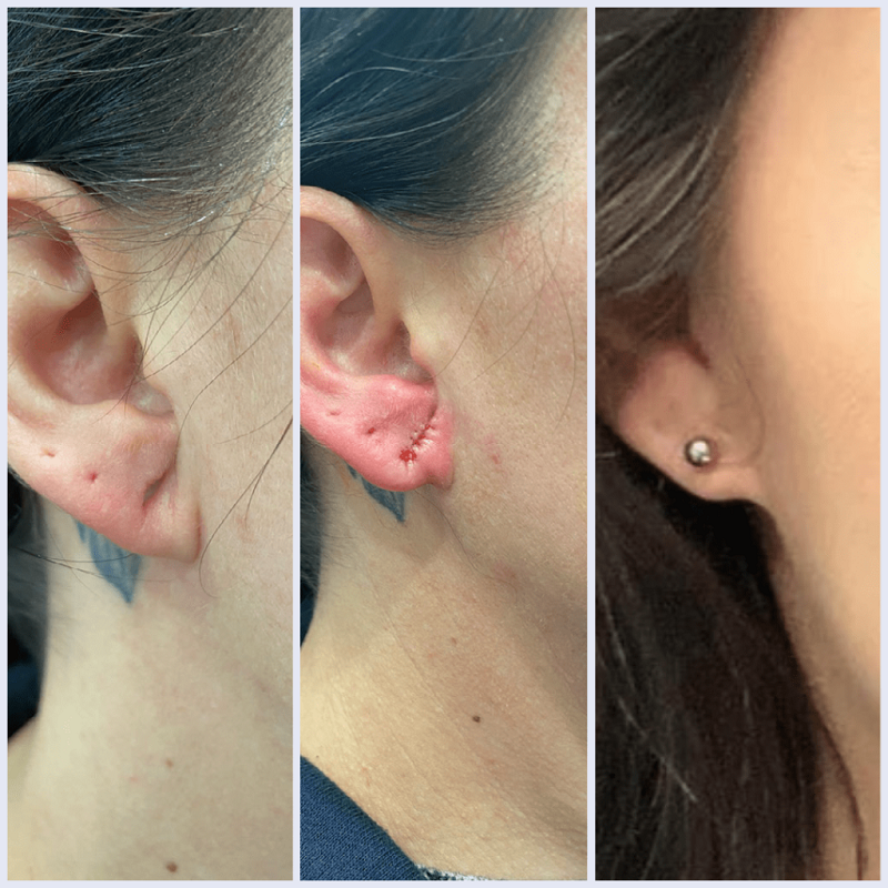 Earlobe Repair before and after