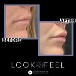 Photo of Filler Treatments