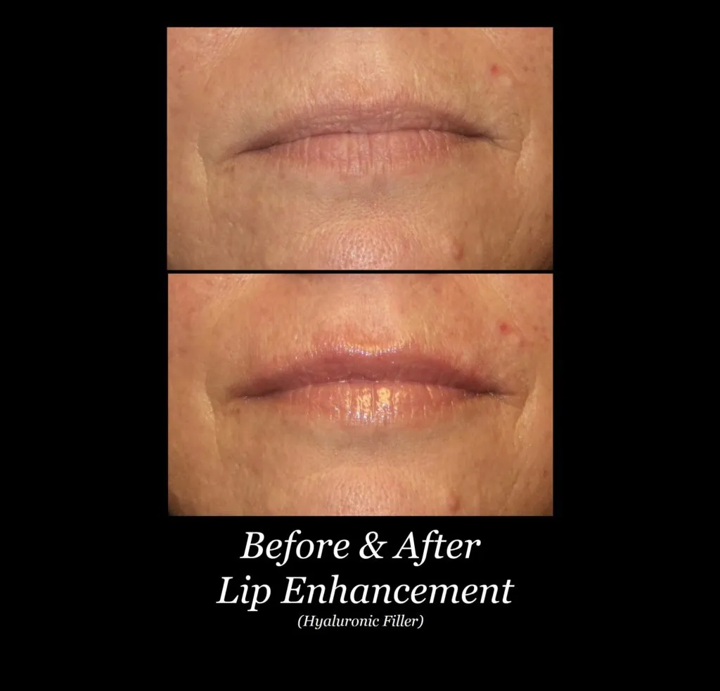 Photo of Filler Treatments
