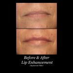 Photo of Filler Treatments