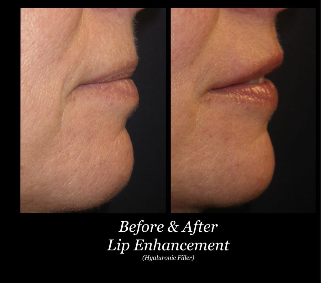 Photo of Filler Treatments