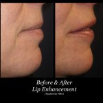 Photo of Filler Treatments