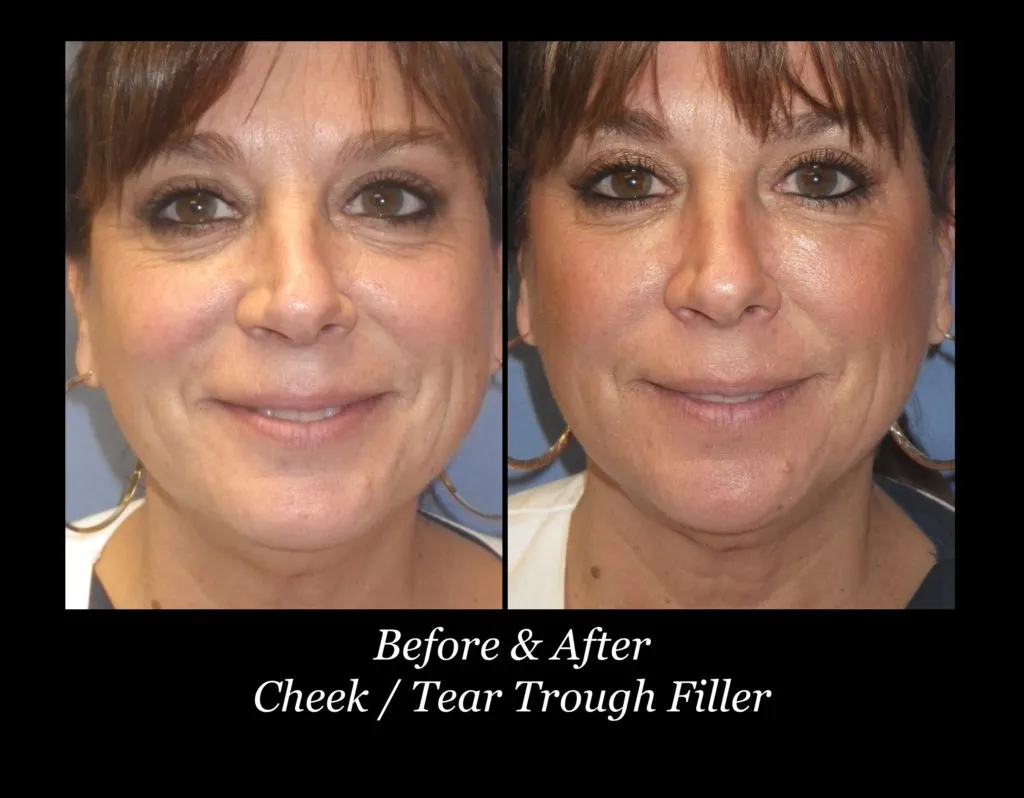 Photo of Filler Treatments