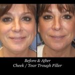 Photo of Filler Treatments