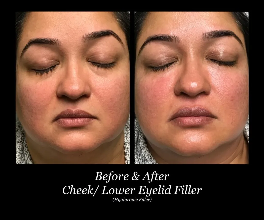 Photo of Filler Treatments