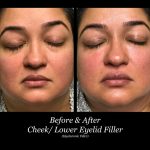 Photo of Filler Treatments