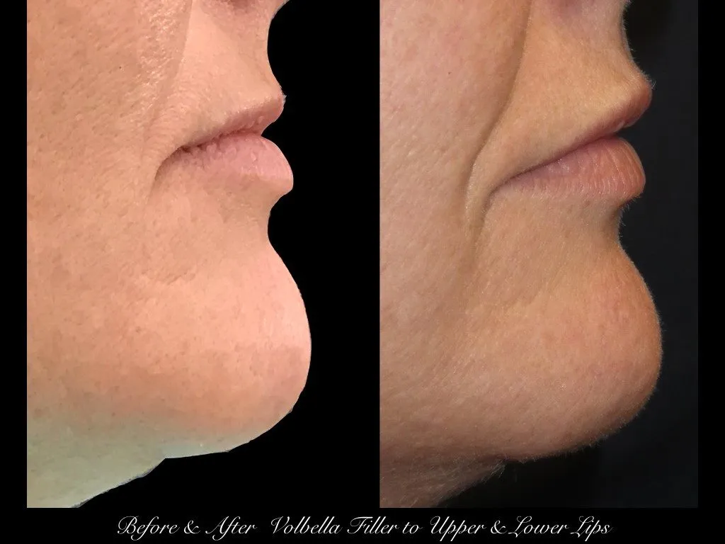 Photo of Filler Treatments