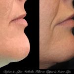 Photo of Filler Treatments