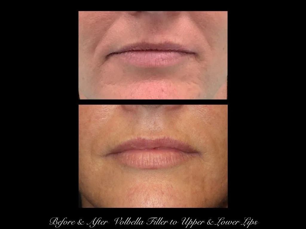 Photo of Filler Treatments